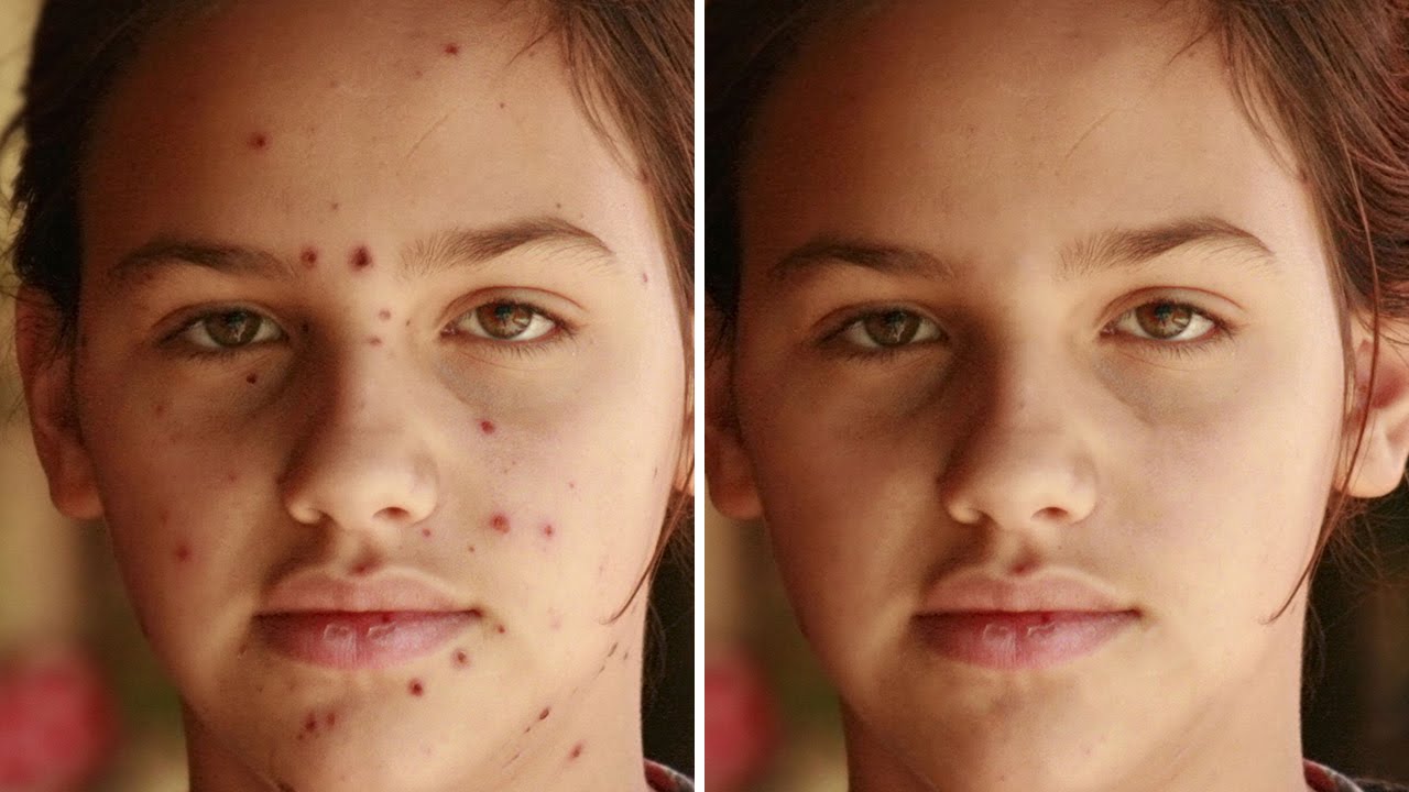 How to Remove Acne or pimples with Spot Healing Brush in Photoshop