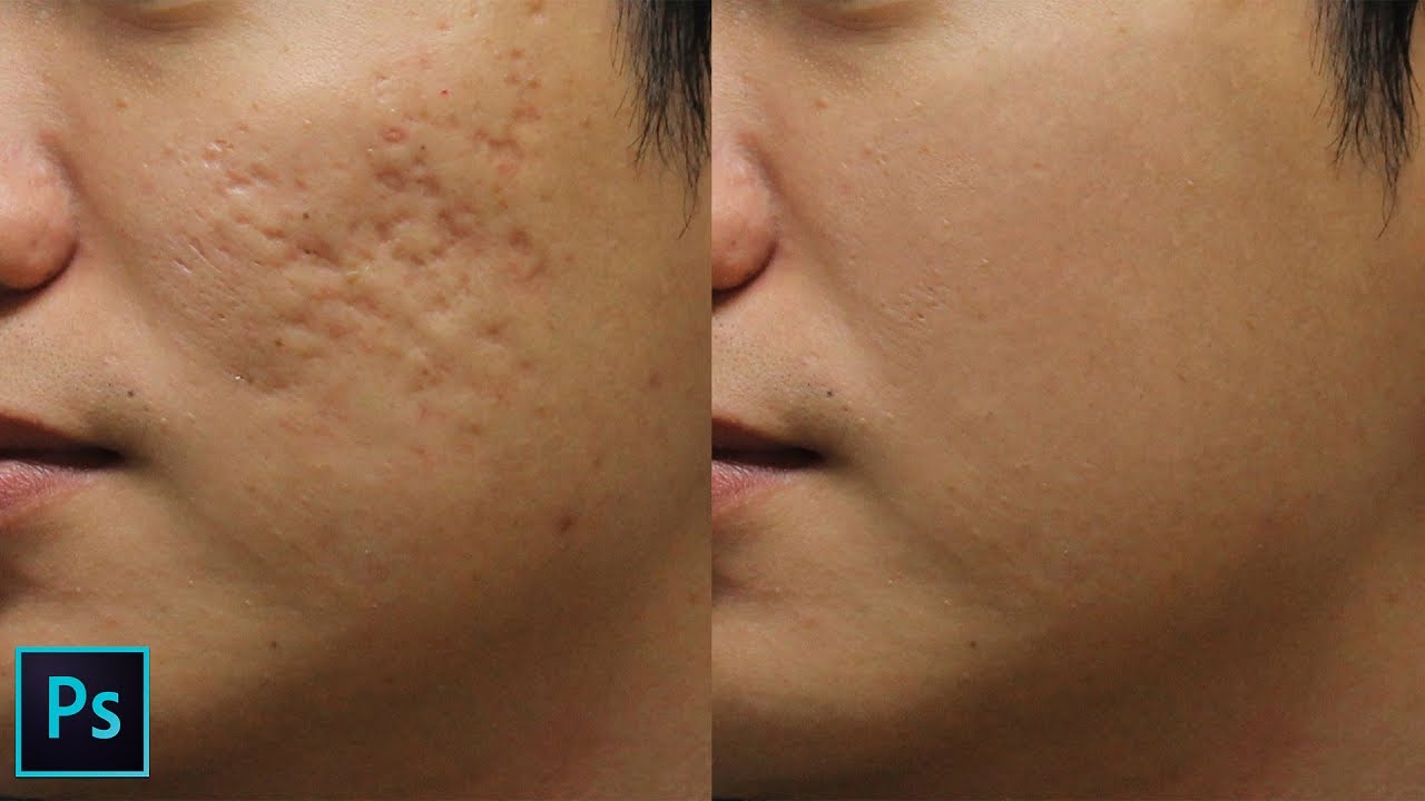 How to Remove Holes on Skin Caused by Acne Scars in Photoshop